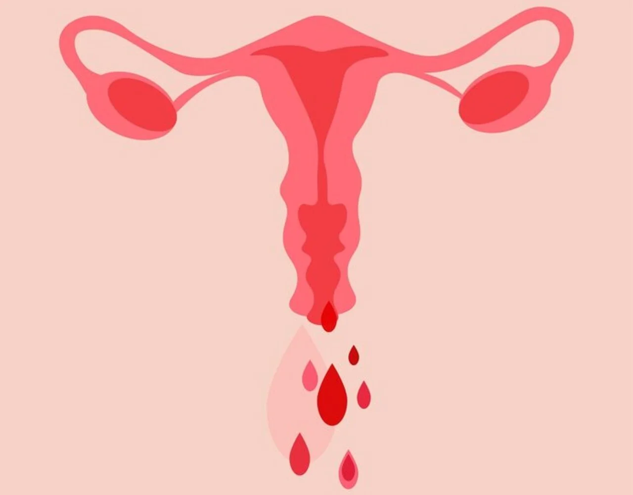 abnormal-bleeding-