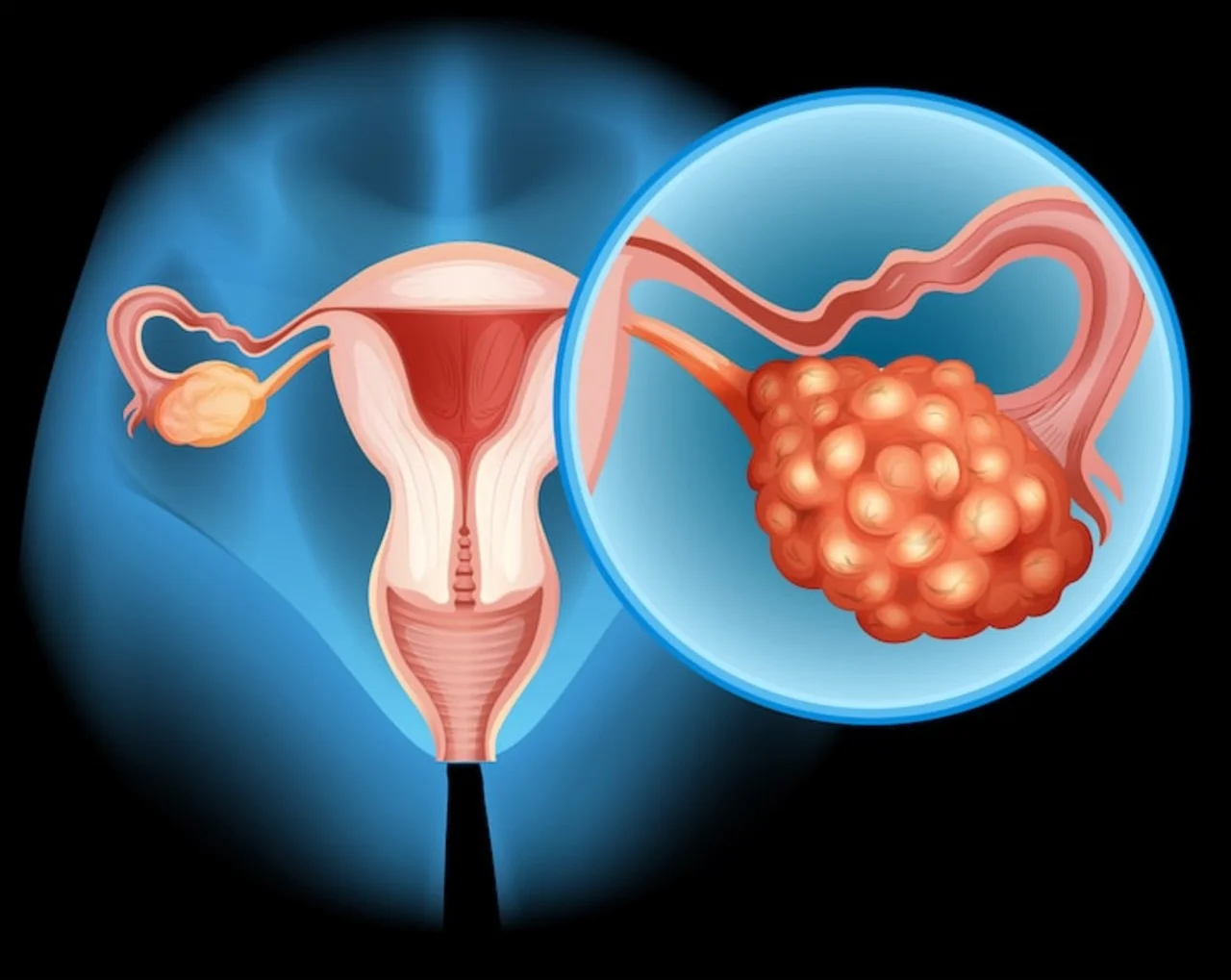 ovarian-cyst