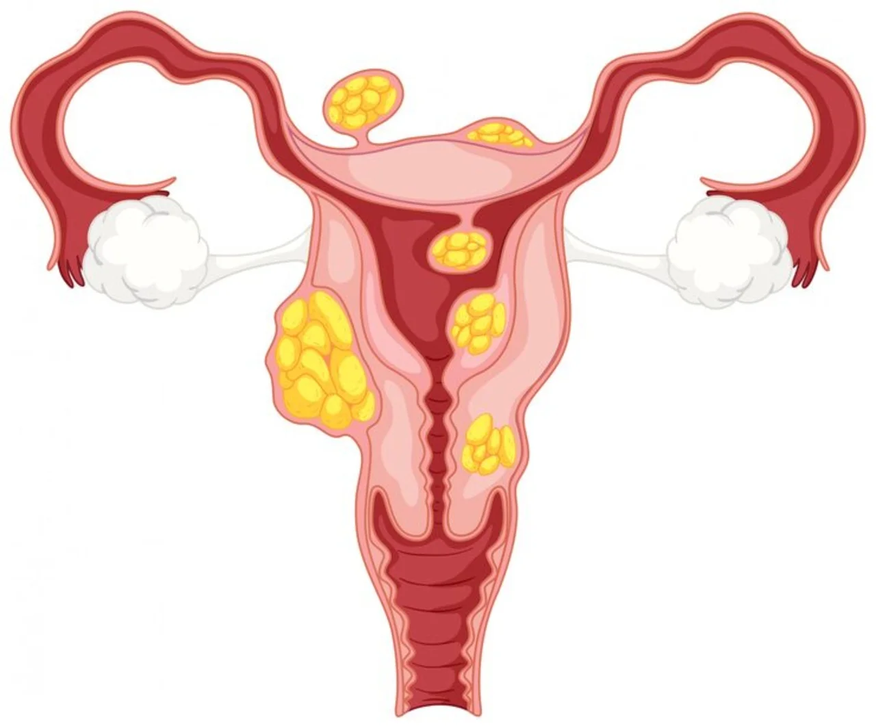 uterine-fibroids-